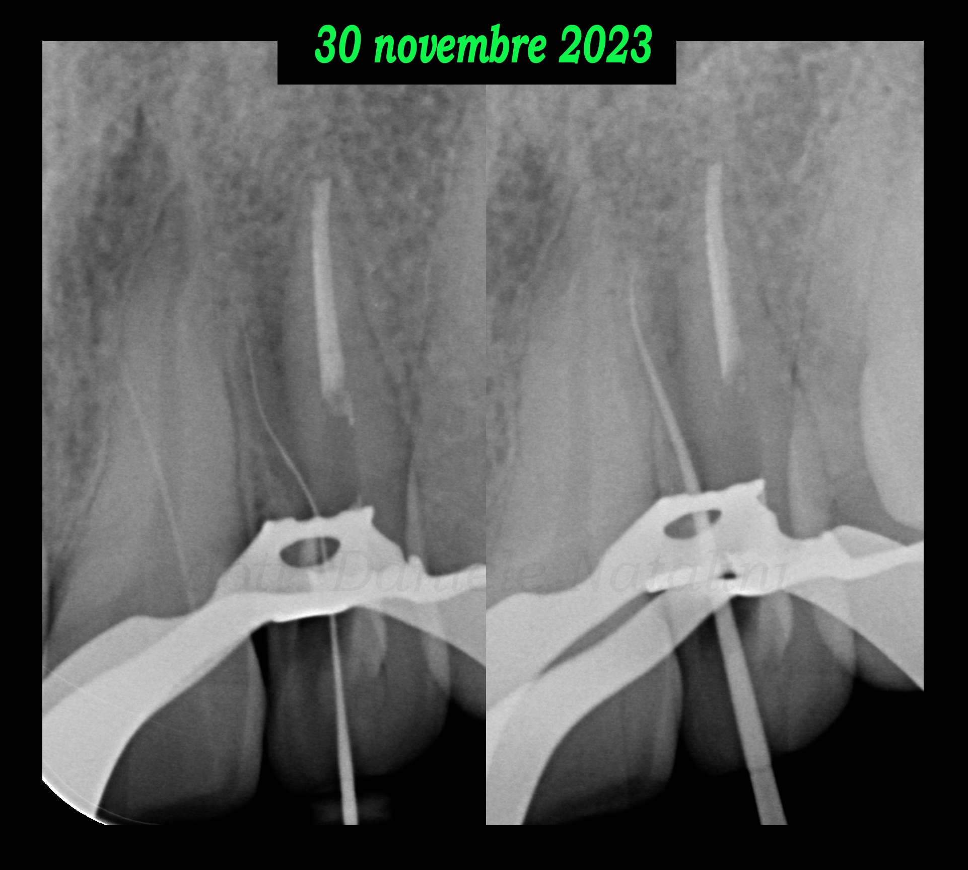 Trattamento endodontico di un incisivo laterale superiore con due radici - parte 10