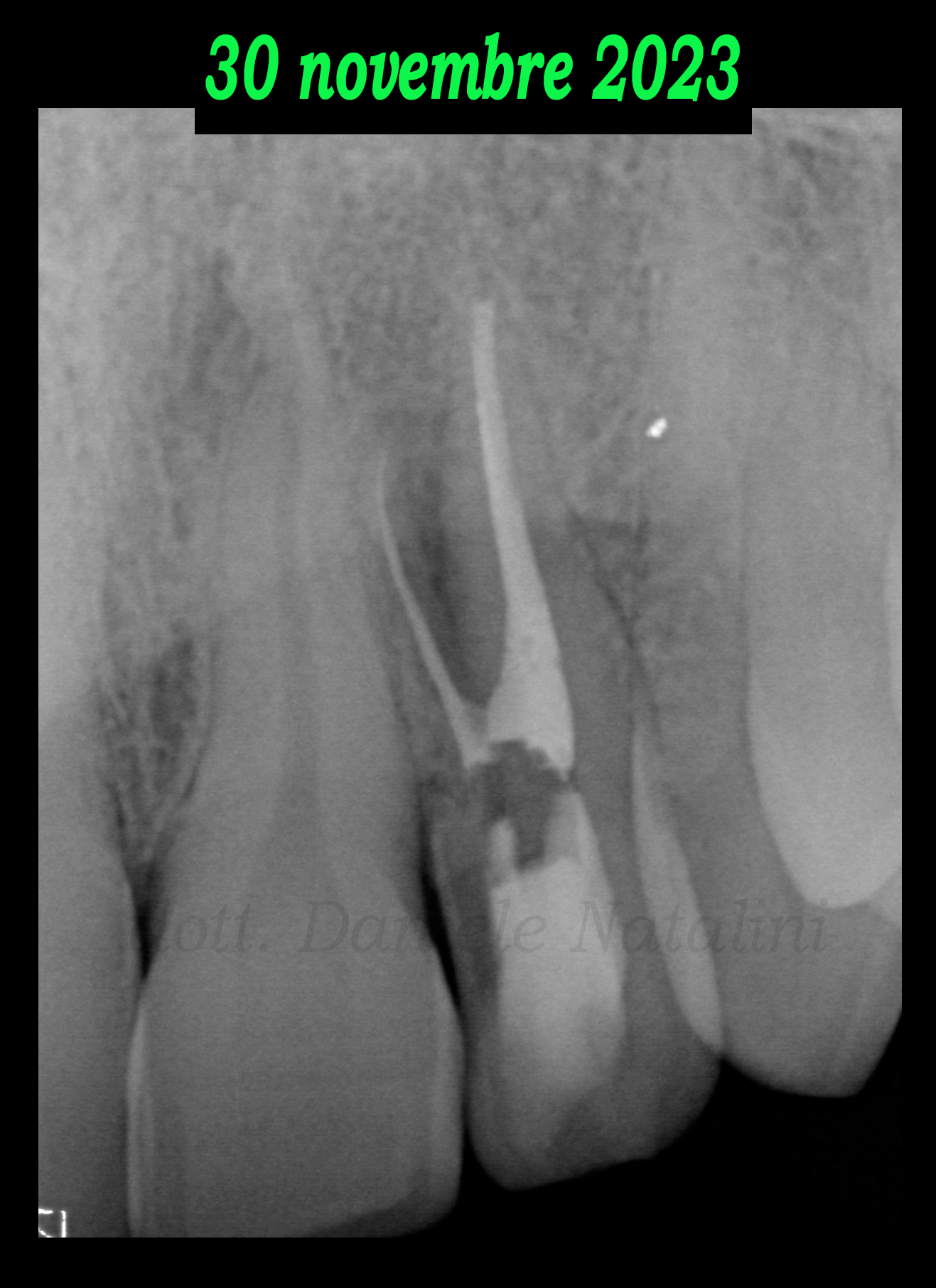 Trattamento endodontico di un incisivo laterale superiore con due radici - parte 11