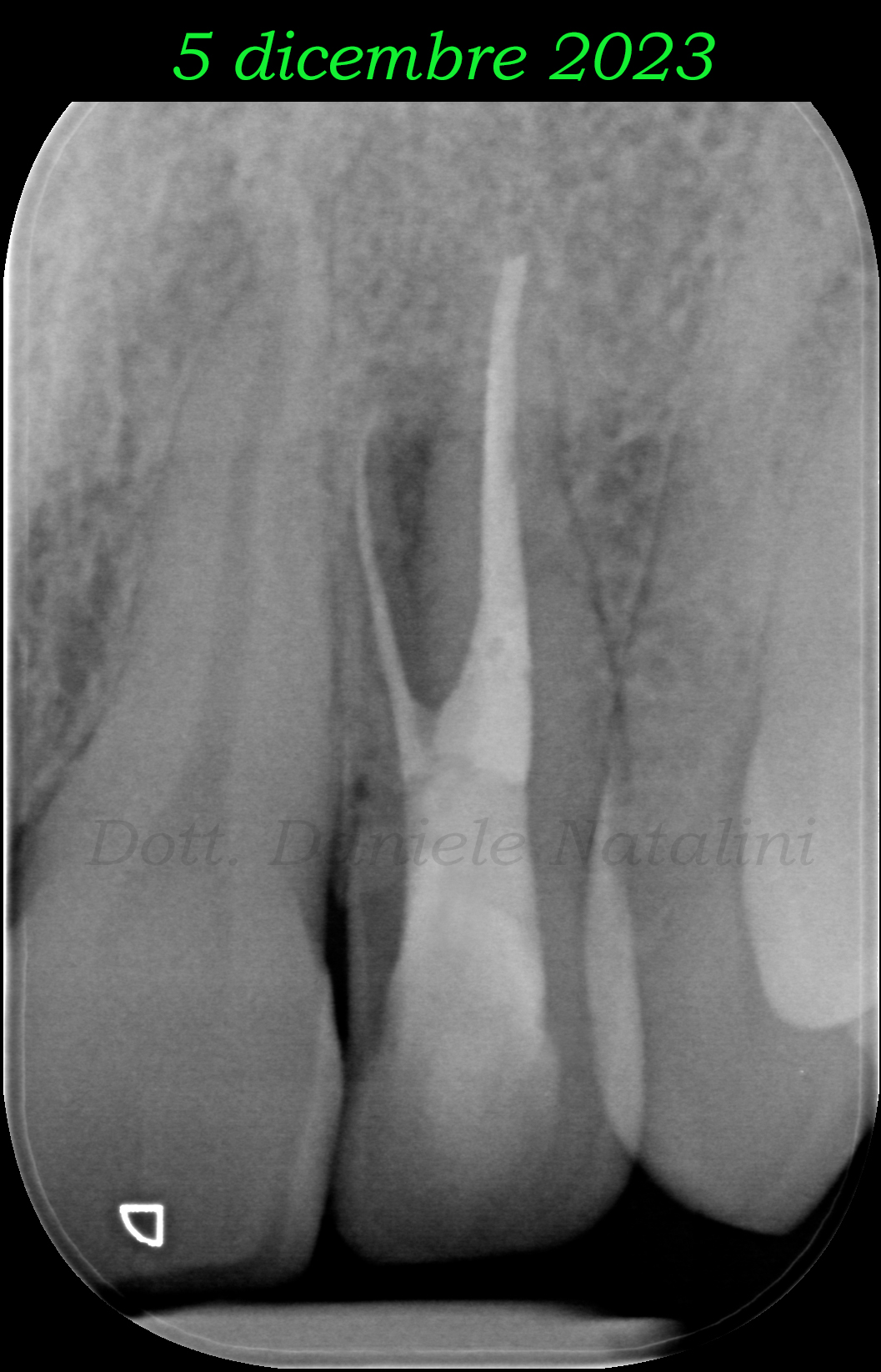 Trattamento endodontico di un incisivo laterale superiore con due radici - parte 12