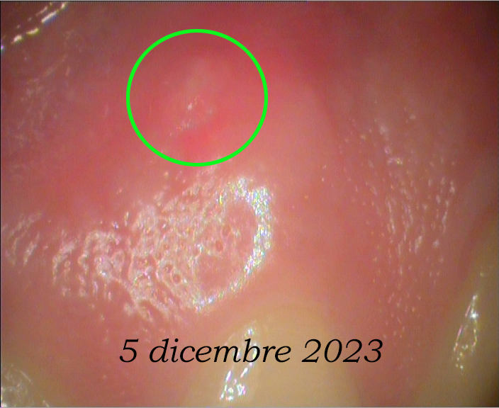 Scomparsa della fistola