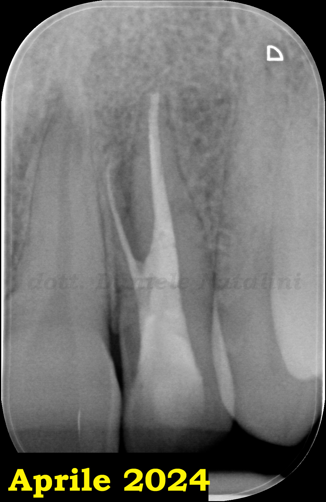 Trattamento endodontico di un incisivo laterale superiore con due radici - parte 15