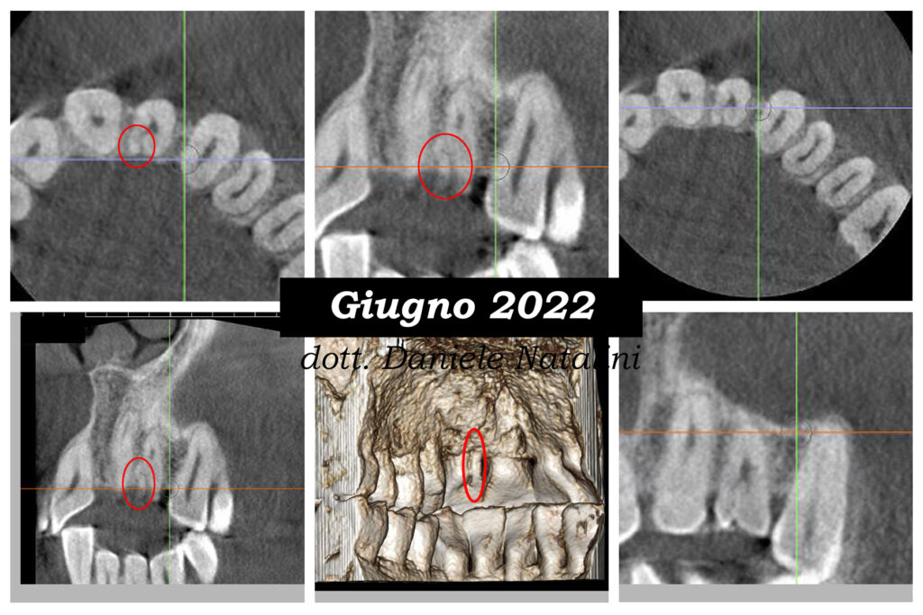 Trattamento endodontico di un incisivo laterale superiore con due radici - parte 3