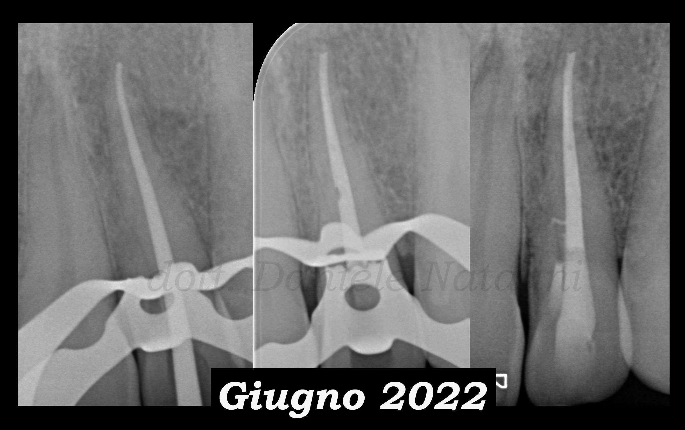 Trattamento endodontico di un incisivo laterale superiore con due radici - parte 5