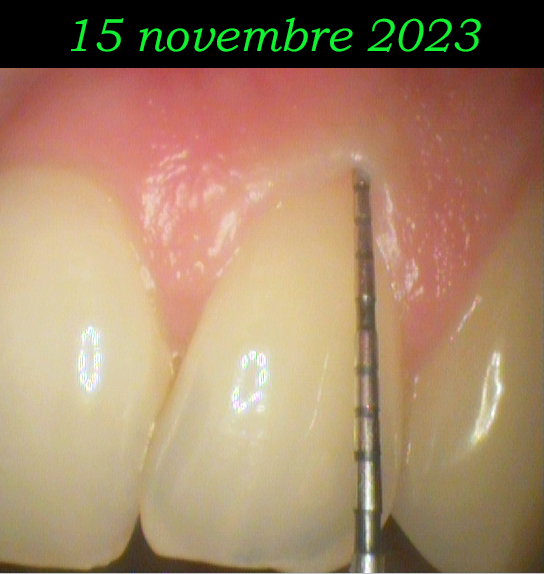 Trattamento endodontico di un incisivo laterale superiore con due radici - parte 6