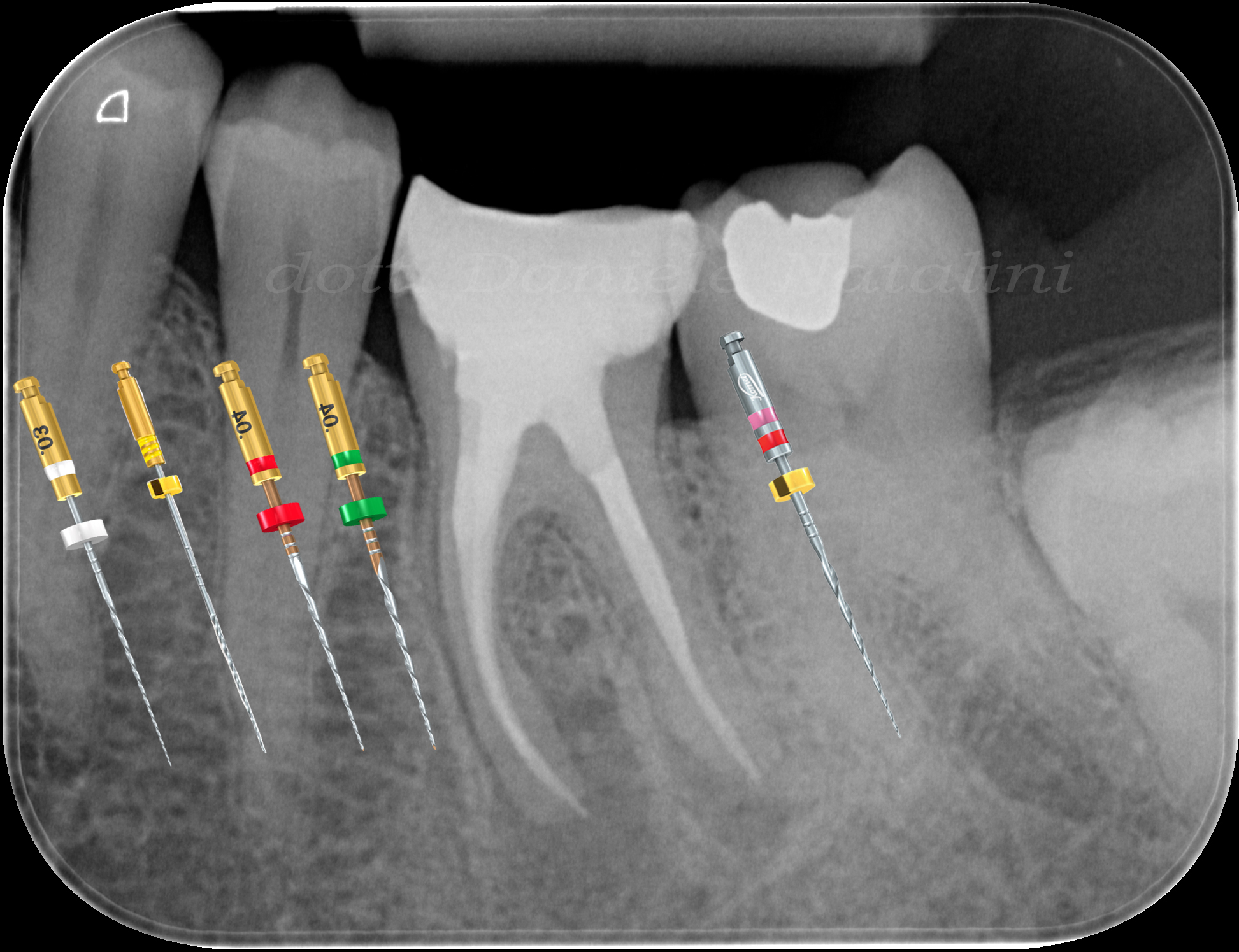 4 - Strumenti FQ ed Endo ReStart