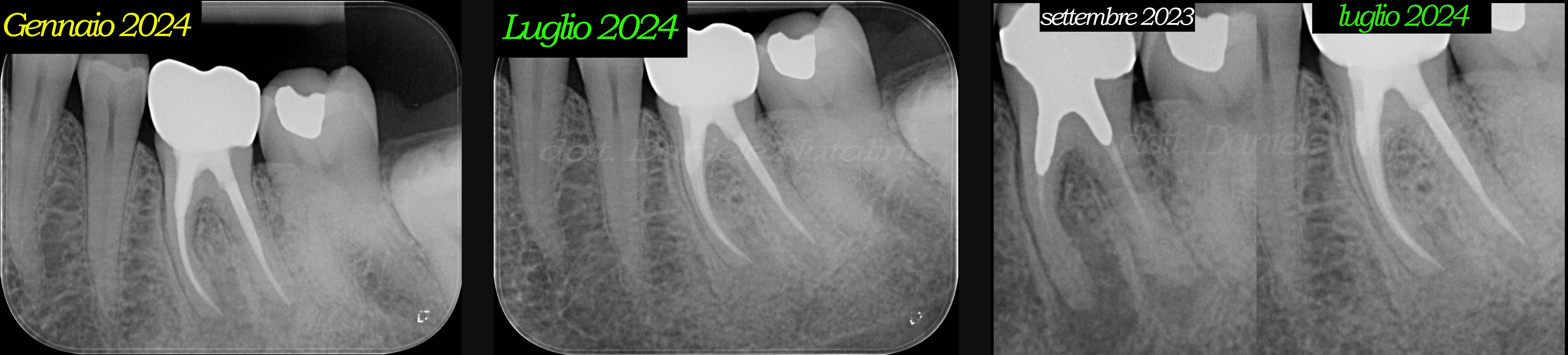 Radiografie a tempi diversi pre e post ritrattamento